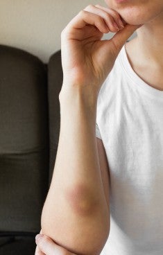 Blåmärke på kvinnas arm