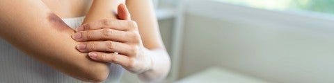 Kvinna med blåmärke på arm