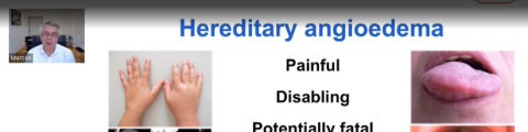 Developments in management of pediatric HAE