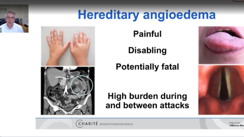 Developments in management of pediatric HAE